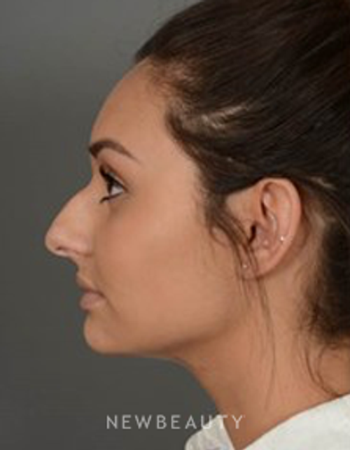 Dr. David Kim - Rhinoplasty - Before