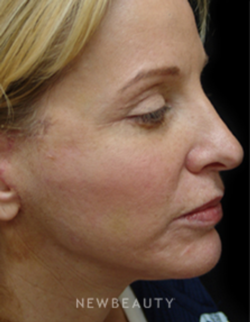 Dr. Mokhtar Asaadi Eyelid Lift, Facelift, Necklift - After