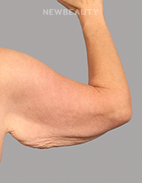 Dr. Mahabir - Arm Lift - 20638033 - Before