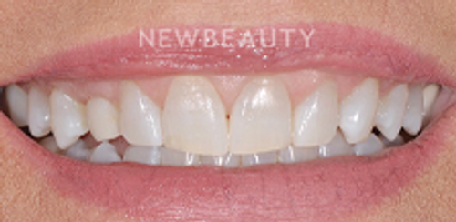 Dr. Salvator La Mastra - Smile Makeover - 46107405 - Before