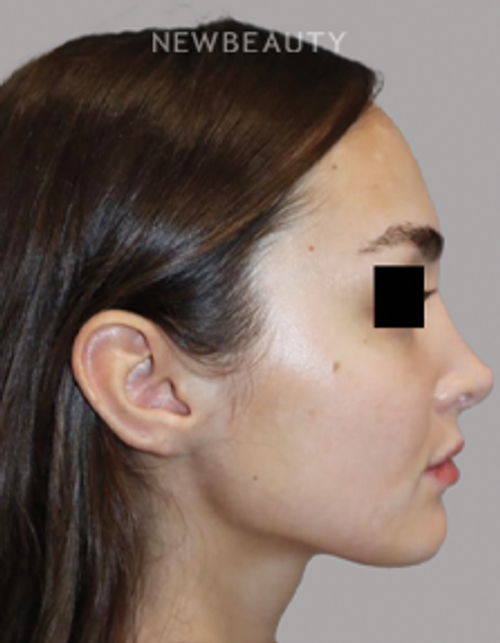 Dr. Sanjay Grover - Rhinoplasty - 49727911 - After