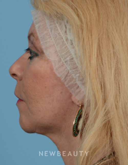 Dr. Jeffrey Wise - Facelift - After