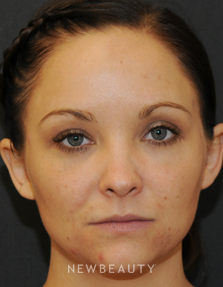 Dr. Janet Allenby - Skin treatments - After