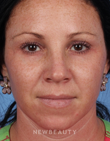 Dr. Kelly Bomer – Chemical Peels, Microneedling - Before