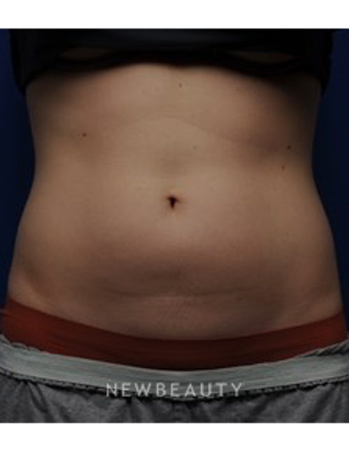 Dr. Gilly Munavalli - UltraShape - Before