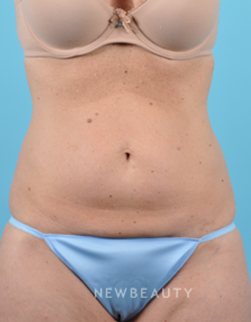 Dr. Bradley Bengtson - CoolSculpting - Before