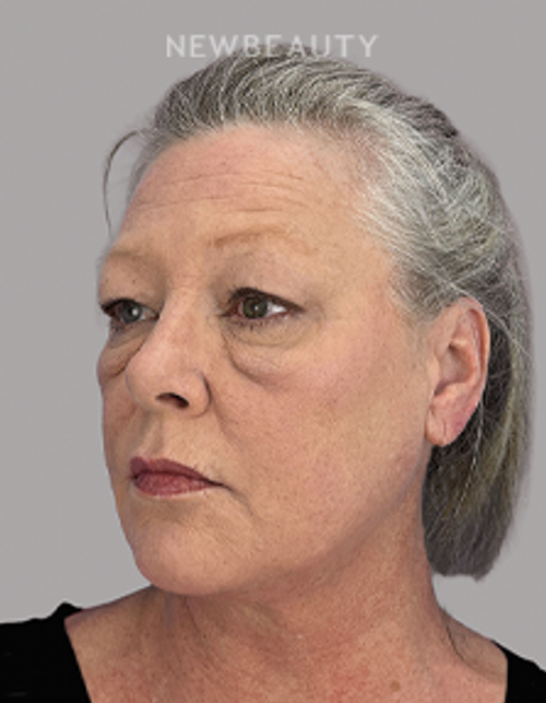 Dr. Sheila Barbarino-Blepharoplasty-54799251 - Before