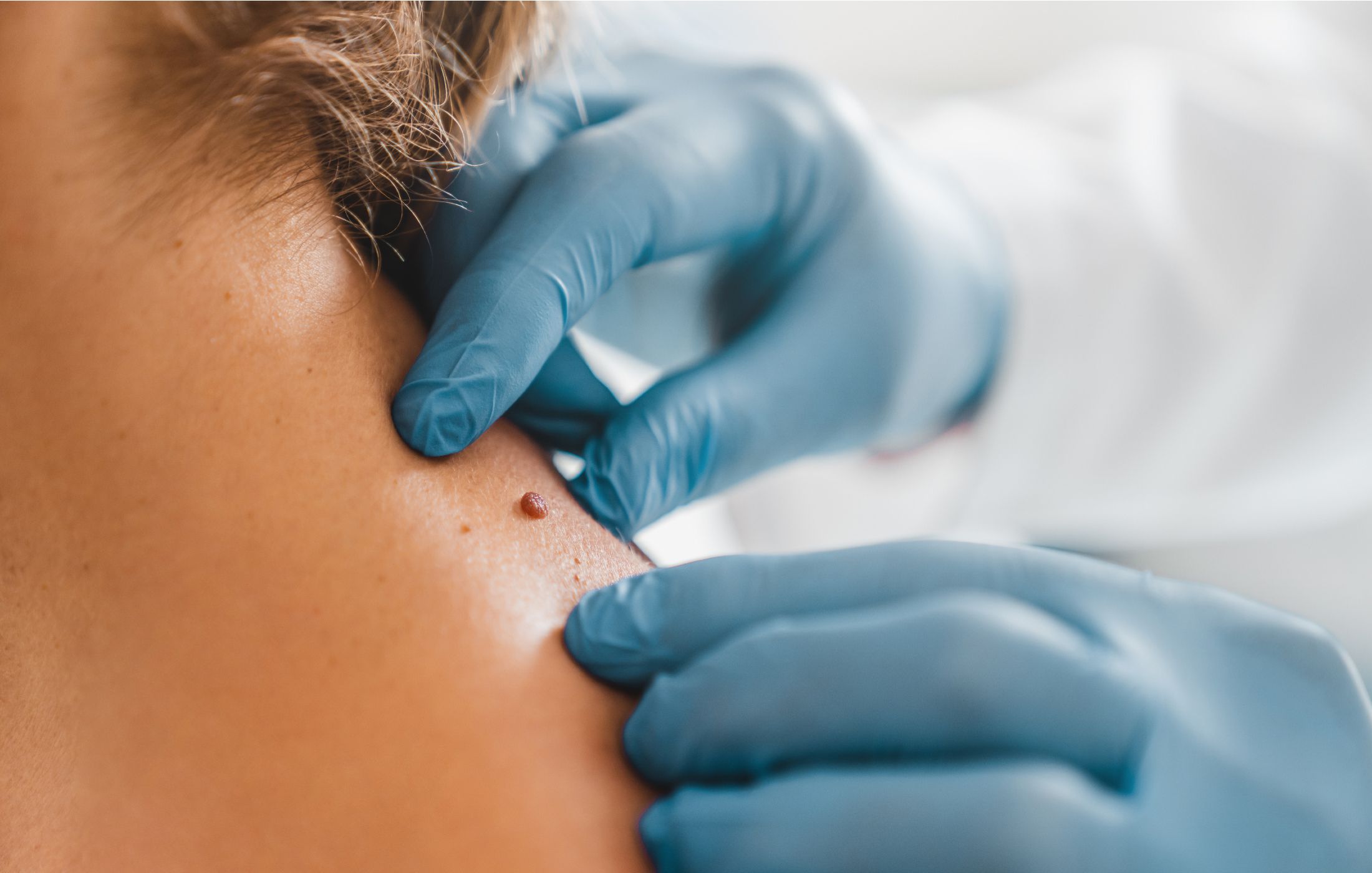 Close-up of a dermatologist or physician assistant examining a mole on a patient