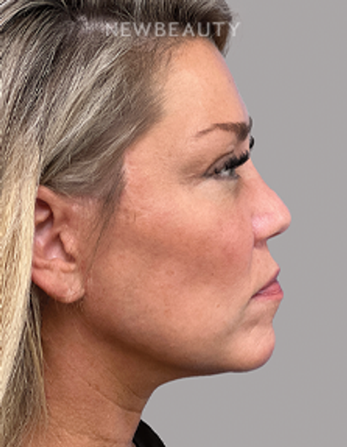Dr. Michael A. Epstein - Elegant Facial Rejuvenation - 33109024 - After
