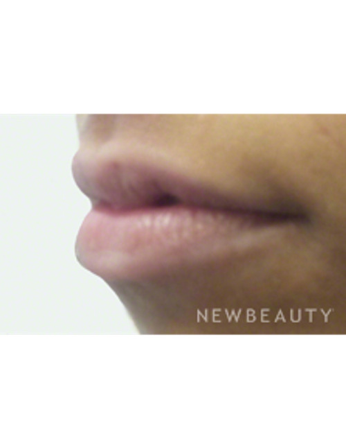Dr. Kally Papantoniou - Volumizing Lips - Before