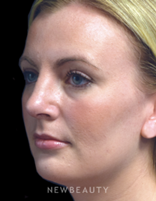 Dr. Jeffrey B. Wise - Natural-Looking Enhancement - After