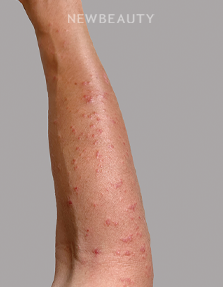 Dr. Anna Chacon – Skin Treatment - 34277007 - Before