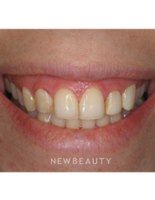 Dr. Irene Grafman - Smile Makeover - Before