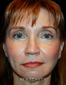 Dr. Kelly Bomer Liquid Facelift - After