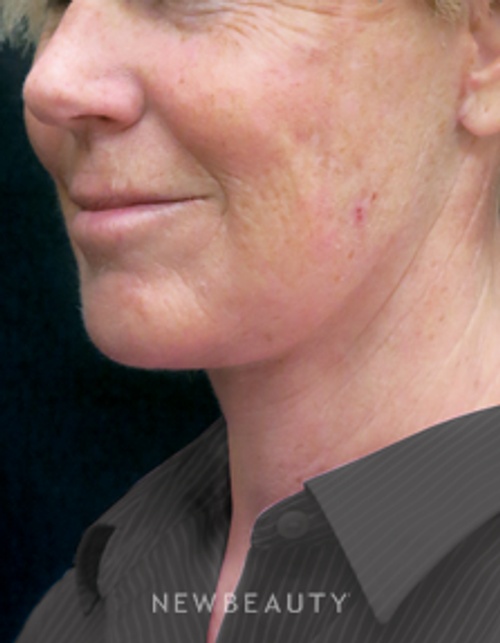 Dr. Elie Levine - Facelift, Necklift, Chin Augmentation - After