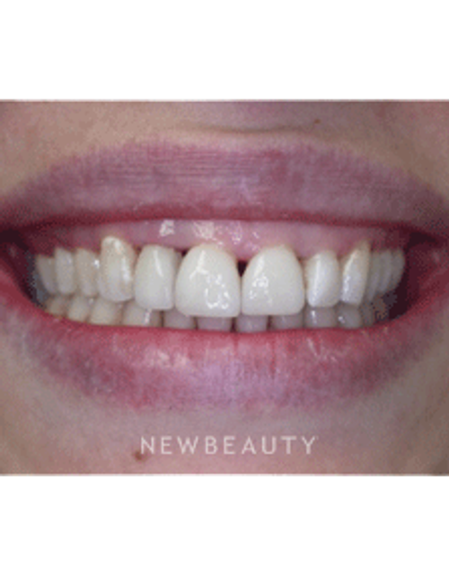 Dr. Irene Grafman Smile Makeover - Before