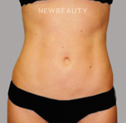 Dr. Sanjay Grover - Liposuction - 49728022 - After