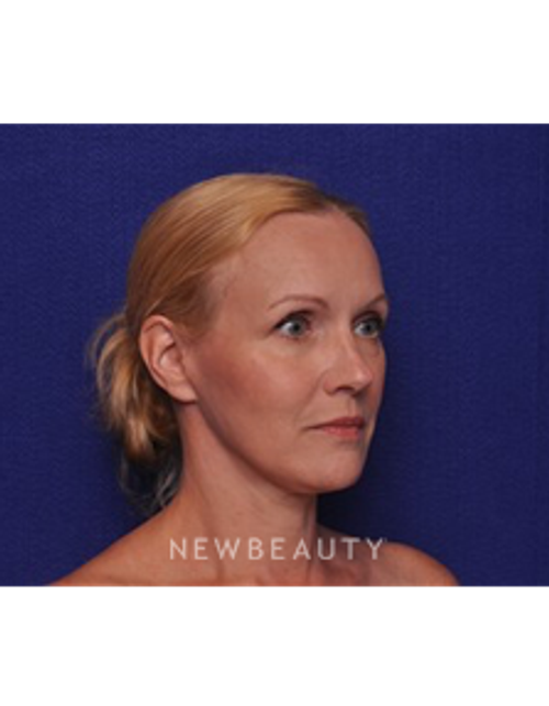 Dr. Alan J. Durkin- Blepharoplasty - After