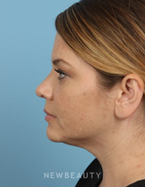 Dr. Kathleen L. Behr - Kybella - After