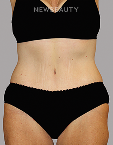 Dr. Lily Lee - Tummy Tuck - 46336045 - After