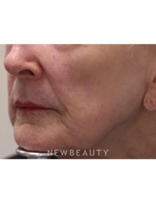 Dr. Gilly Munavalli - Lasers - After