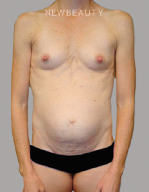 Dr. Sanjay Grover - Mommy Makeover - 49714070 - Before