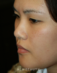 Dr. John Kang - Upper Blepharoplasty & Rhinoplasty - Before