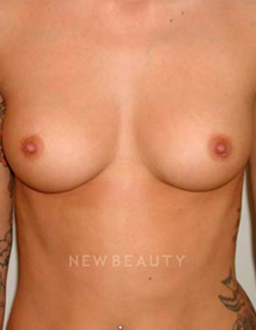 Dr. Michael Horn Silicone Breast Implants - Before