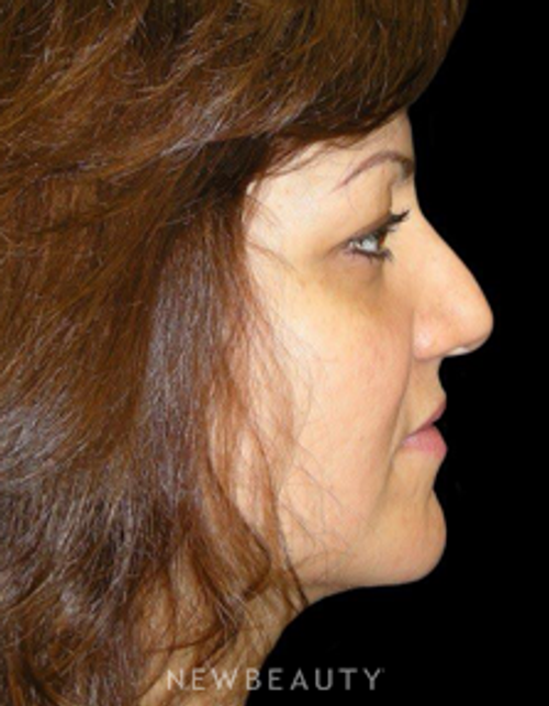 Dr. Elie Levine - Rhinoplasty - Before