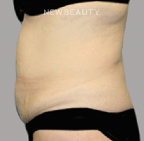 Dr. Christine Hamori - Tummy Tuck - Before