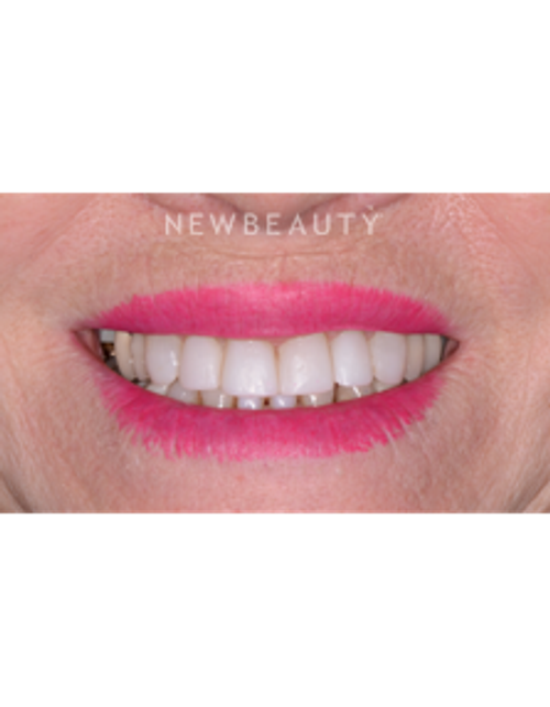 Dr. Irene Grafman - Dental Bonging - After