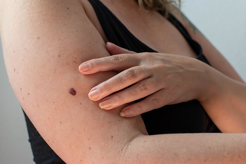 A woman with a concerning mole on her arm which needs to be removed