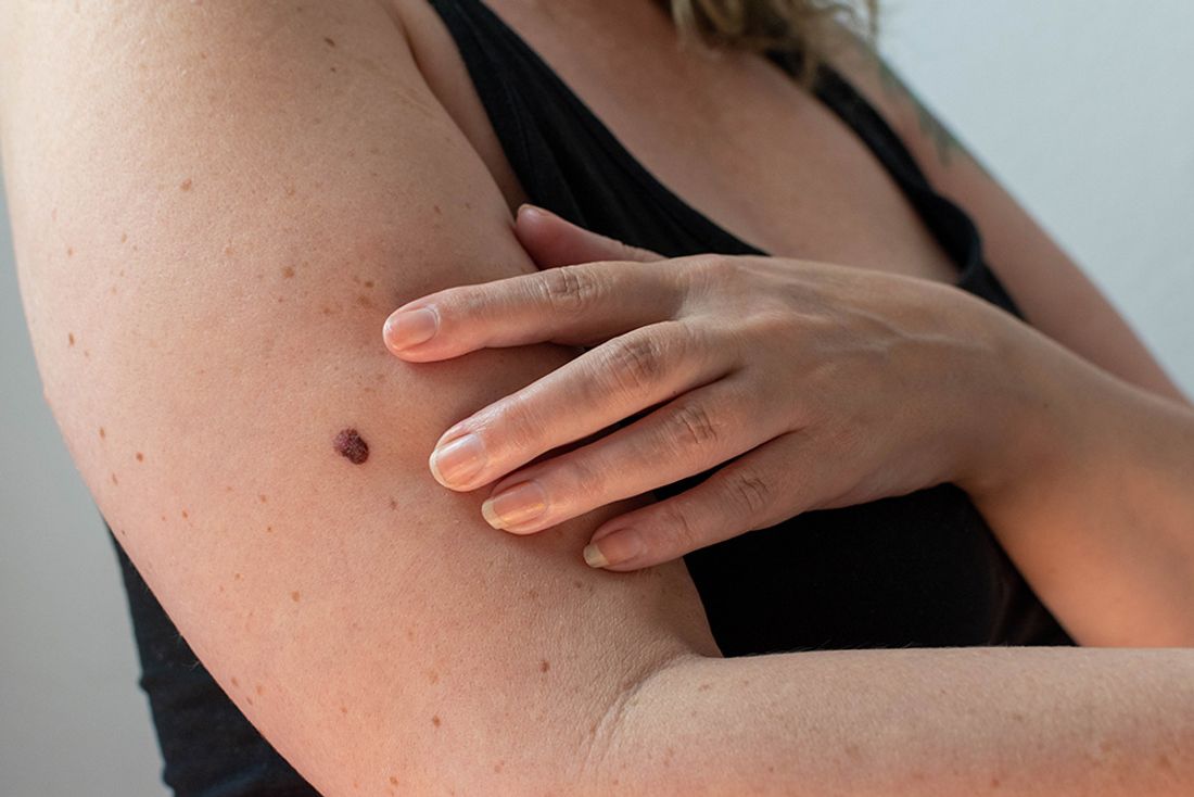 A woman with a concerning mole on her arm which needs to be removed