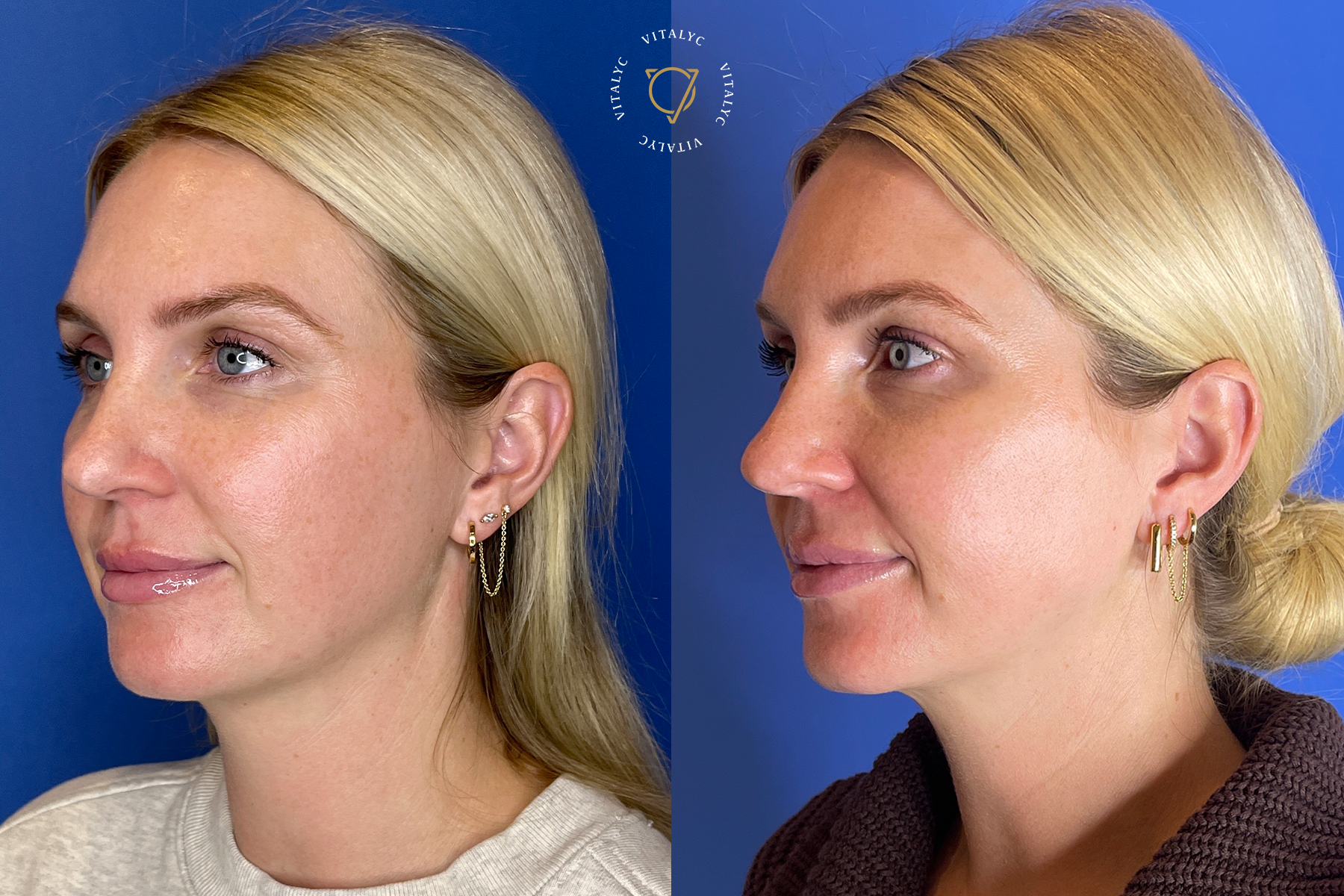 Meggan Morehead of Somewhere, Lately Shares Her Skin-Transformation Journey with Emface