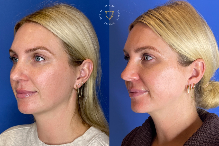 Meggan Morehead of Somewhere, Lately Shares Her Skin-Transformation Journey with Emface