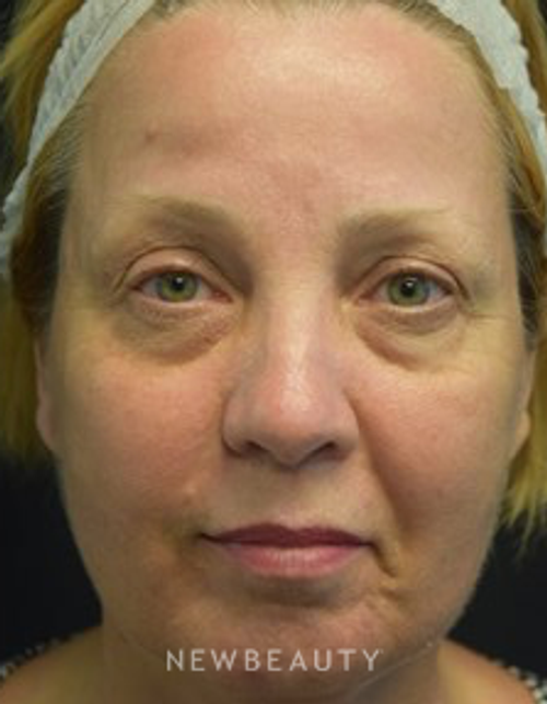 Dr. Jeffrey B. Wise - Eyelift - Before