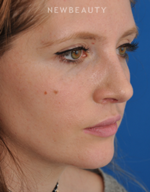 Dr. Edward Kwak - Rhinoplasty - After