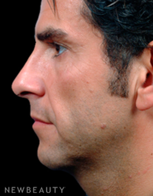 Dr. Steven Bloch Rhinoplasty - After