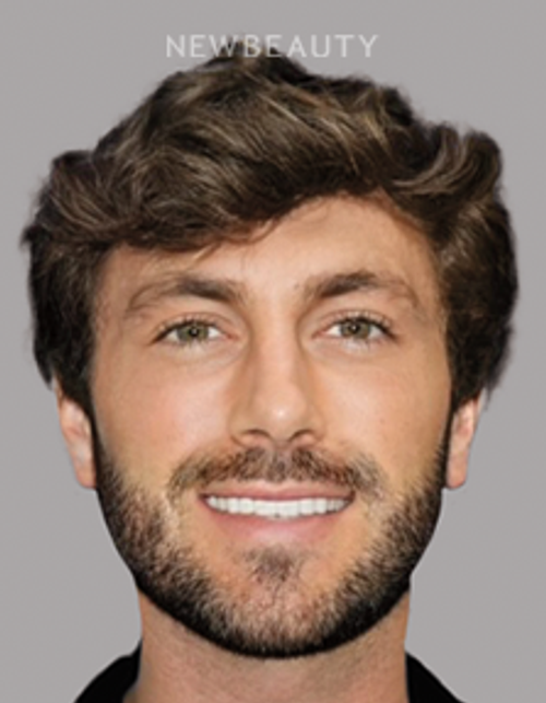 Dr. Salvator La Mastra - Smile Makeover -46108507 - After