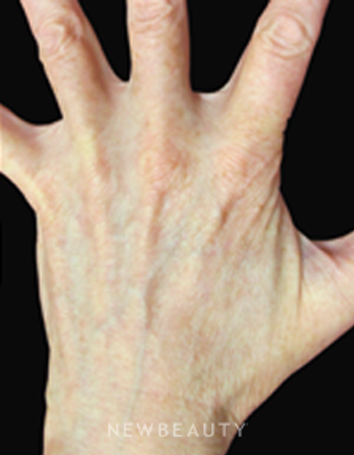 Dr. Jody Levine Lasers - After