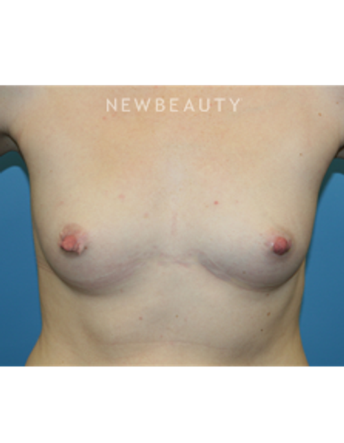 Dr. Christine Hamori - Larger Bust - Before