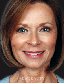 Dr. Kelly Bomer Facelift, Chin Implant, Blepharoplasty, Lip Augmentation, Chemical Peel, IPL - After