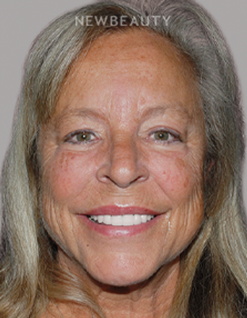 Dr. Salvator La Mastra - Smile Makeover -46108276 - After