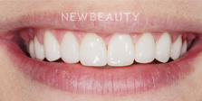 Dr. Nathan Hoffman - Gum Lift, Teeth Whitening & Veneers - After