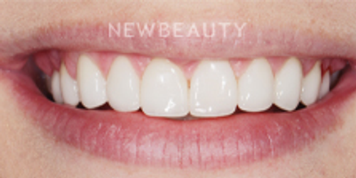 Dr. Nathan Hoffman - Gum Lift, Teeth Whitening & Veneers - After