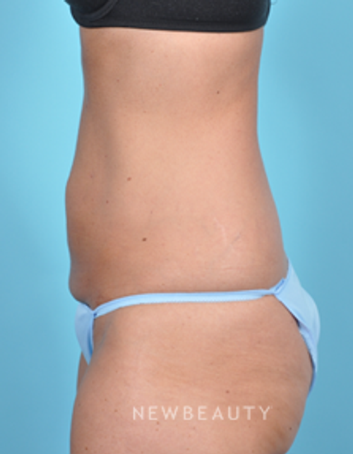 Dr. Bradley Bengtson - CoolSculpting - After