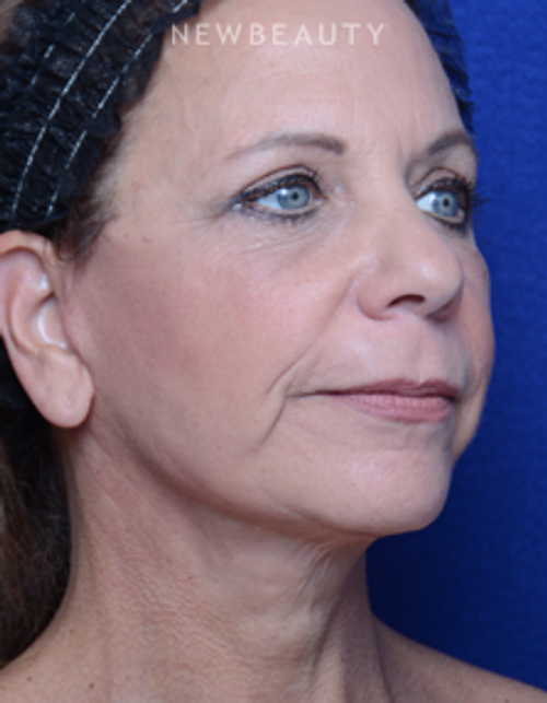 Dr. Alan Durkin - Facelift - After