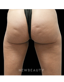 Dr. Julie Russak - Cellulite - Before