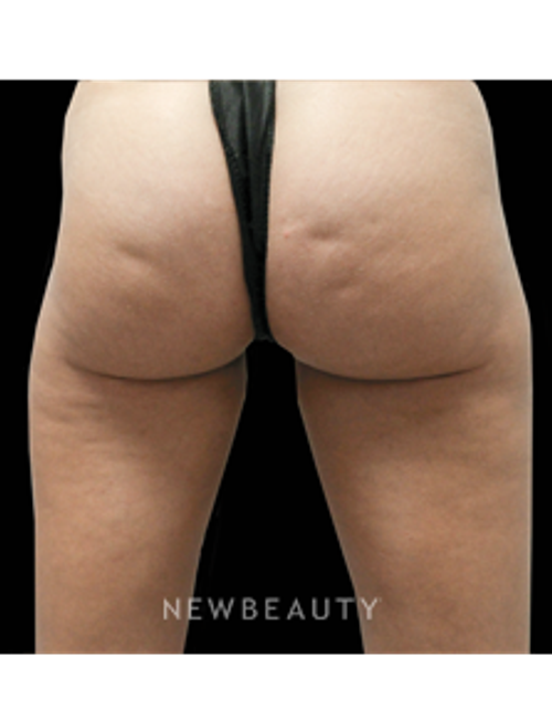 Dr. Julie Russak - Cellulite - Before