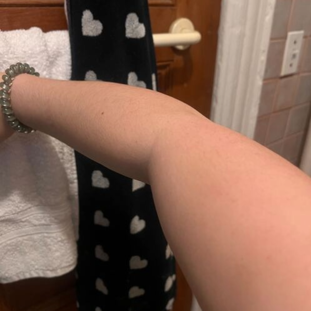 after saltyface on arm